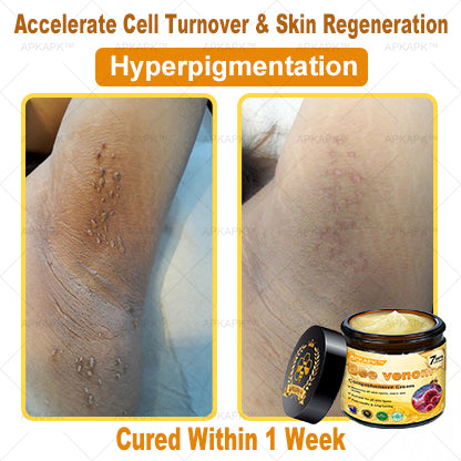 𝐀𝐏𝐊𝐀𝐏𝐊™ Bee Venom Comprehensive Cream (Suitable for all ages & TGA recommends)🔥🔥