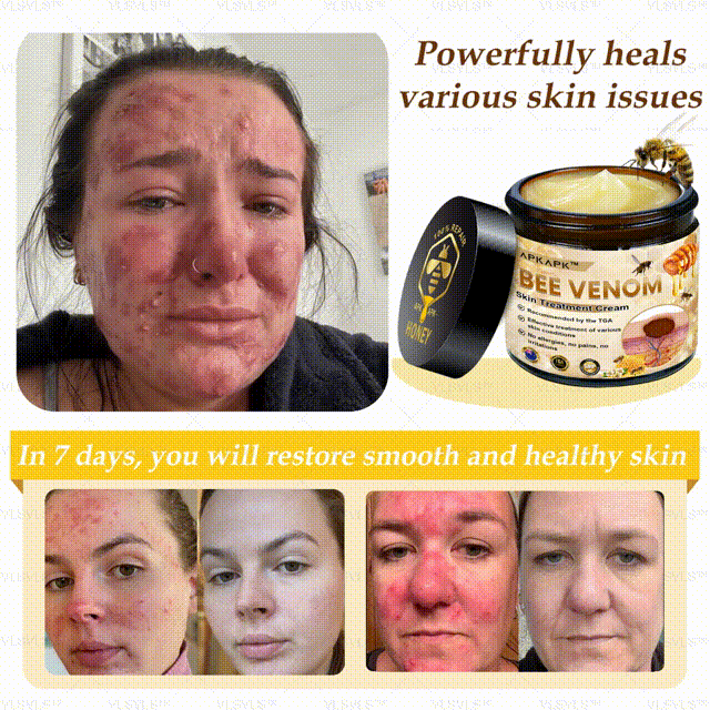 𝐀𝐏𝐊𝐀𝐏𝐊™ Bee Venom Comprehensive Cream (Suitable for all ages & TGA recommends)🔥🔥