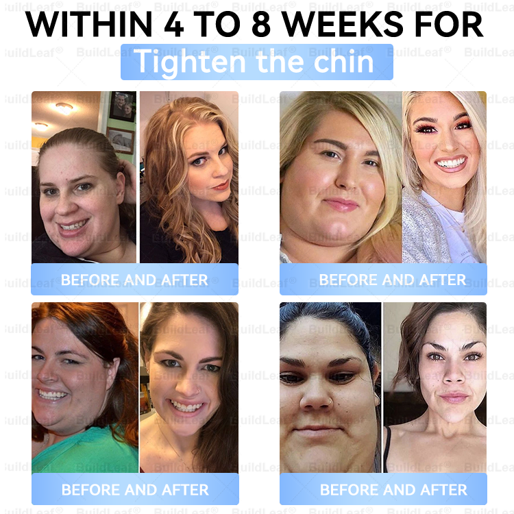 𝑶𝒇𝒇𝒊𝒄𝒊𝒂𝒍 𝑺𝒕𝒐𝒓𝒆|🏥𝐵uil𝗱𝐿ea𝐟® 𝑮𝐋𝑃-1 Slim & Firm 𝑁ano 𝑀icroneedle 𝑃atch with Collagen,Turmeric&Matrixyl 3000 丨Obesity,Cardiovascular Diseas, Diabetes, Sleep Apnea, Joint Problems and More