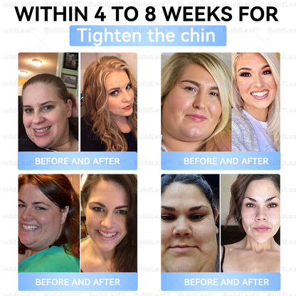 𝑶𝒇𝒇𝒊𝒄𝒊𝒂𝒍 𝑺𝒕𝒐𝒓𝒆|🏥𝐵uil𝗱𝐿ea𝐟® 𝑮𝐋𝑃-1 Slim & Firm 𝑁ano 𝑀icroneedle 𝑃atch with Collagen,Turmeric&Matrixyl 3000 丨Obesity,Cardiovascular Diseas, Diabetes, Sleep Apnea, Joint Problems and More