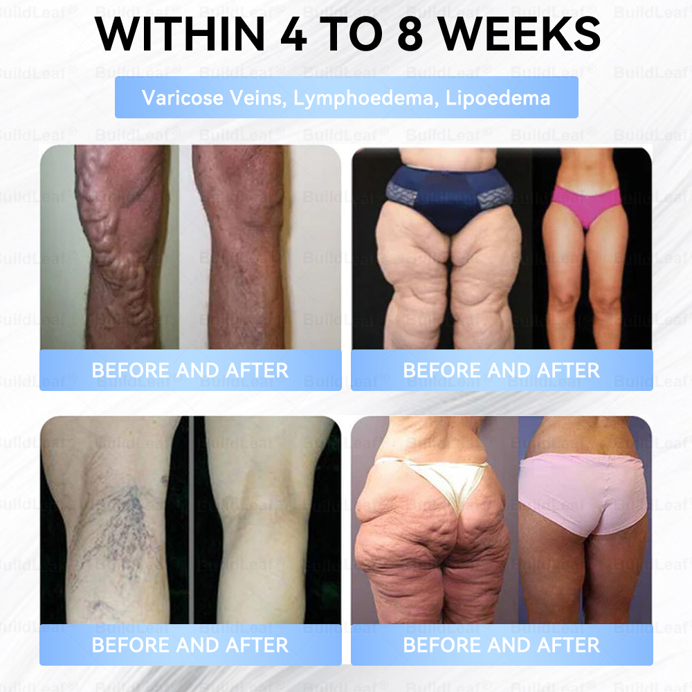 𝑶𝒇𝒇𝒊𝒄𝒊𝒂𝒍 𝑺𝒕𝒐𝒓𝒆|🏥𝐵uil𝗱𝐿ea𝐟® 𝑮𝐋𝑃-1 Slim & Firm 𝑁ano 𝑀icroneedle 𝑃atch with Collagen,Turmeric&Matrixyl 3000 丨Obesity,Cardiovascular Diseas, Diabetes, Sleep Apnea, Joint Problems and More