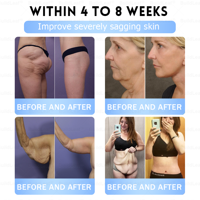 𝑶𝒇𝒇𝒊𝒄𝒊𝒂𝒍 𝑺𝒕𝒐𝒓𝒆|🏥𝐵uil𝗱𝐿ea𝐟® 𝑮𝐋𝑃-1 Slim & Firm 𝑁ano 𝑀icroneedle 𝑃atch with Collagen,Turmeric&Matrixyl 3000 丨Obesity,Cardiovascular Diseas, Diabetes, Sleep Apnea, Joint Problems and More