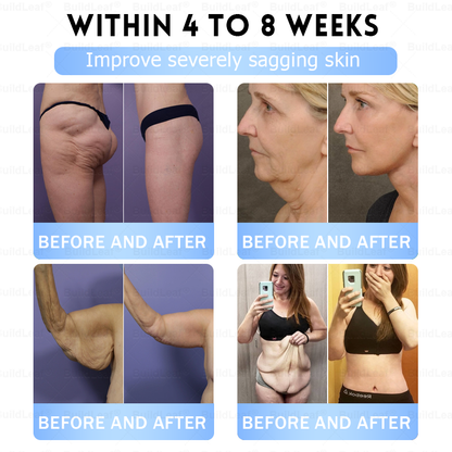 𝑶𝒇𝒇𝒊𝒄𝒊𝒂𝒍 𝑺𝒕𝒐𝒓𝒆|🏥𝐵uil𝗱𝐿ea𝐟® 𝑮𝐋𝑃-1 Slim & Firm 𝑁ano 𝑀icroneedle 𝑃atch with Collagen,Turmeric&Matrixyl 3000 丨Obesity,Cardiovascular Diseas, Diabetes, Sleep Apnea, Joint Problems and More